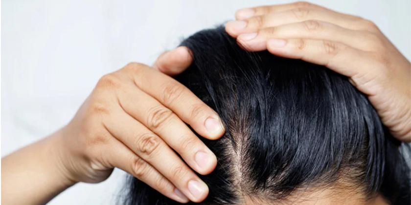 AGA（男性型脱毛症）/FPHL（女性型脱毛症）とは