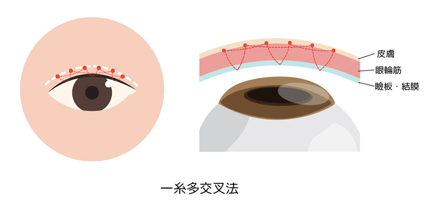 一糸皮膚挙筋多交叉